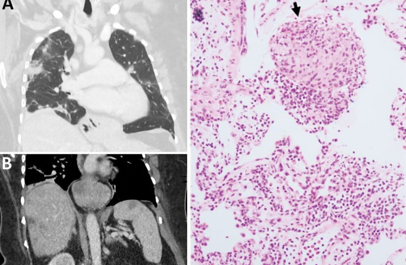 Early testing conducted during investigation of illness in a 64-year-old woman from southeastern New South Wales, Australia, who was later determined to have Ophidascaris robertsi nematode infection. (credit: The Journal of Emerging Infectious Diseases) Early testing conducted during investigation of illness in a 64-year-old woman from southeastern New South Wales, Australia, who was later determined to have Ophidascaris robertsi nematode infection. (credit: The Journal of Emerging Infectious Diseases)